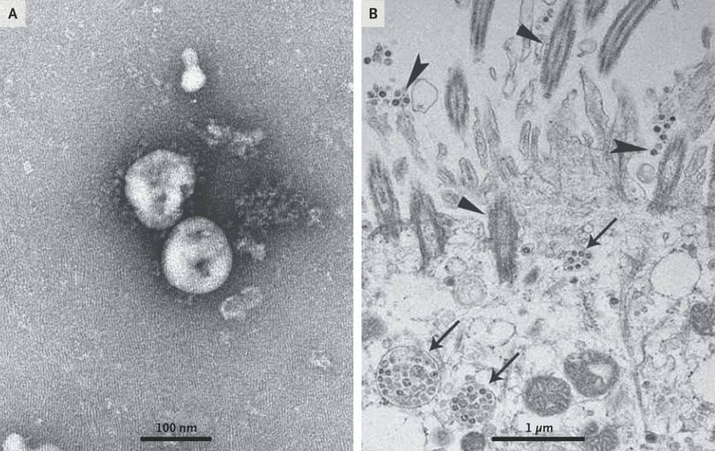 Visualización del coronavirus COVID-19 mediante microscopio electrónico de transmisión (Zhu et al., 2020).