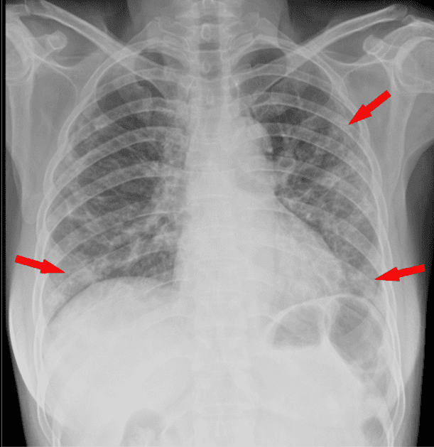 Radiografía de pecho de un paciente de 53 años