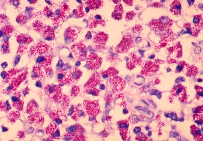 Mycobacterium tuberculosis - Tinción de Ziehl-Neelsen